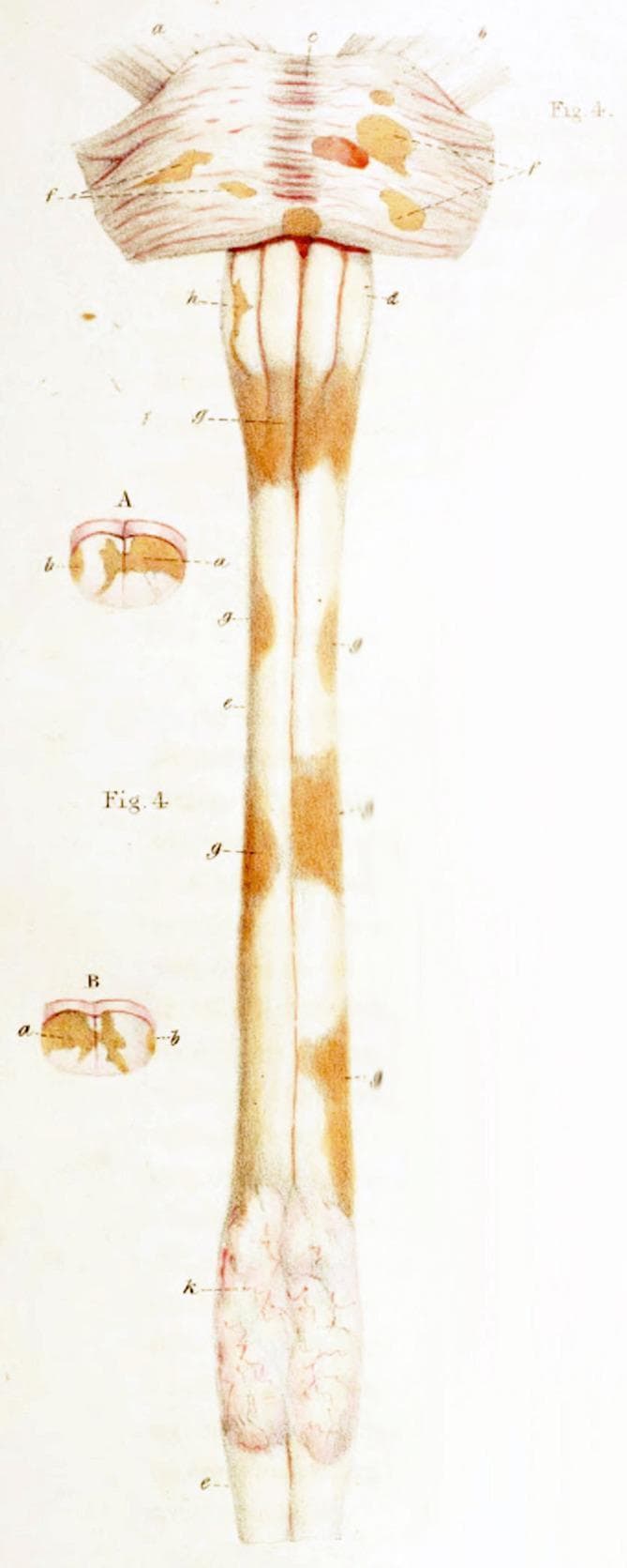 This historical medical illustration by Sir Robert Carswell depicts pathological gross specimens of the human spinal cord and brainstem, demonstrating spinal sclerotic lesions associated with Multiple Sclerosis (MS). The primary image shows a posterior view of the spinal cord, from the medulla oblongata to the conus medullaris. Key features include multifocal, irregular patches of brownish-tan discoloration (labeled 'g') representing demyelinated plaques, which contrast with the surrounding white, healthy-appearing tissue. The brainstem region displays similar sclerotic markings and vascular congestion. Two transverse cross-sections, labeled 'A' and 'B', illustrate the deep extension of these lesions into the spinal parenchyma, involving both white and gray matter tracts. The distal spinal cord shows a more vascularized, slightly bulbous appearance with visible surface microvasculature. This illustration is a seminal anatomical-pathological record of neuro-inflammatory disease progression, highlighting the morphology and distribution of demyelinating lesions in the central nervous system.