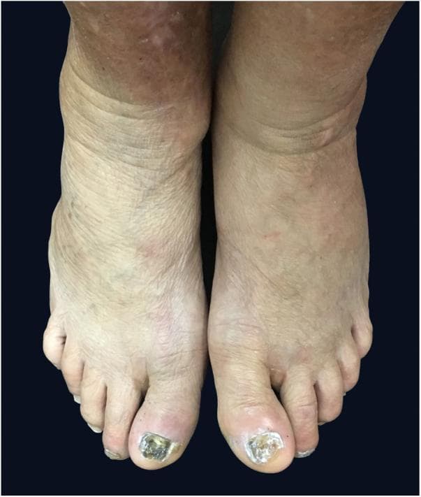 Clinical photograph of the bilateral feet and ankles of a patient with primary hypothyroidism. The image demonstrates significant dermatological and soft tissue manifestations associated with myxedema. Both ankles and the pretibial regions show non-pitting edema (malleolar edema), characterized by swelling and a thickened, pale, and waxy skin appearance with prominent transverse skin creases. The hallux (big toe) on both feet displays advanced nail dystrophy, including thickening of the nail plate, rough texture, and marked discoloration with yellowish and dark-pigmented areas. The skin appears thin and fragile with evidence of xeroderma (dry skin). These visual findings are classic clinical indicators of endocrine-related cutaneous changes, specifically reflecting the systemic effects of thyroid hormone deficiency on connective tissue and integumentary health. The photograph serves as an educational example of how systemic metabolic diseases can present with localized distal extremity findings like myxedematous edema and onychodystrophy.