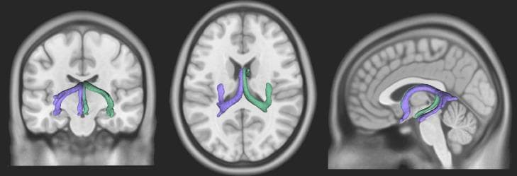 This diagnostic visualization presents a three-dimensional reconstruction of the human fornix superimposed on T1-weighted magnetic resonance imaging (MRI) slices. The graphic displays the fornix in three standard anatomical planes: coronal (left), axial (center), and sagittal (right). The fornix, a key white matter bundle of the limbic system, is color-coded to differentiate bilateral symmetric bands (purple and green). In the sagittal view, the characteristic C-shaped arch is highly visible, demonstrating its position inferior to the corpus callosum and superior to the thalamus. The axial and coronal views highlight its spatial relationship to the ventricular system and its course from the hippocampus toward the diencephalon and basal forebrain. This neuroimaging representation is used for educational purposes to demonstrate the 3D trajectory of limbic pathways, including the columns, body, and crura of the fornix, which are essential for memory formation and cognitive function. The visualization was generated using DSI Studio software based on healthy adult anatomy.
