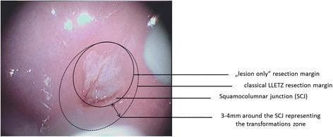 A colposcopic clinical photograph of a cervix showing a comparison of two surgical resection methods for cervical intraepithelial neoplasia (CIN). The image displays an acetowhite dysplastic lesion centered on the squamocolumnar junction (SCJ). Two concentric circular overlays illustrate different surgical margins: a solid line indicates the 'lesion only' resection margin, which closely contours the visible pathology; a larger dashed line represents the 'classical LLETZ' (Large Loop Excision of the Transformation Zone) resection margin, which encompasses the entire transformation zone. The transformation zone is visually defined as extending 3 to 4 mm peripheral to the SCJ. Labels and arrows specify the SCJ, the transformation zone dimensions, and the comparative extent of both excision techniques. This comparison chart serves as an educational tool for gynecological oncology and dysplasia management, highlighting the difference between targeted lesion excision and traditional excision of the whole transformation zone.