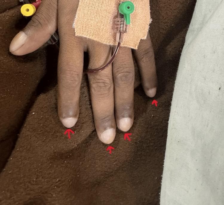 This clinical photograph displays a patient's hand demonstrating grade 3 digital clubbing, a common physical sign of chronic hypoxemia. The fingertips (distal phalanges) appear bulbous and enlarged, described as 'drumstick' morphology. The nails exhibit increased longitudinal curvature and a loss of the normal Lovibond angle at the nail base. Clinical features suggest cyanotic heart disease, supported by the visible medical equipment including a pulse oximetry sensor on the index finger and an intravenous (IV) catheter secured to the dorsal surface of the hand with adhesive dressing. There is evidence of peripheral cyanosis or hyperpigmentation of the distal digits. This visual is highly relevant for medical education regarding cardiovascular and respiratory physical examination findings and the assessment of chronic oxygen deprivation.