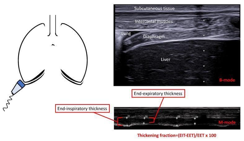 This composite educational graphic illustrates the ultrasonographic assessment of the diaphragm in the zone of opposition. It includes an anatomical diagram showing a linear probe placed in the lower intercostal space, a B-mode ultrasound image, and an M-mode ultrasound image. The B-mode image provides a cross-sectional anatomical view, labeling structures from superficial to deep: subcutaneous tissue, intercostal muscles, the lung, the hypoechogenic diaphragm, and the liver. The M-mode image displays the diaphragm's movement and thickness changes over the respiratory cycle. Key educational concepts shown include the measurement of end-inspiratory thickness (EIT) and end-expiratory thickness (EET). A mathematical formula for calculating the Thickening Fraction (TF) is provided: (EIT - EET) / EET x 100. This methodology is used in clinical settings to evaluate diaphragmatic function, muscle atrophy, and readiness for ventilator weaning by quantifying the muscle's contractile capacity and thickness.