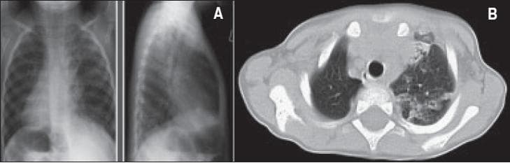 This composite clinical imaging set features a posteroanterior (PA) chest X-ray (A) and an axial CT chest scan (B) of a patient with Kartagener syndrome. Image A demonstrates dextrocardia, with the cardiac apex and right-sided aortic arch oriented toward the right hemithorax. The lung fields show diffuse airspace opacities and signs of chronic lung disease, including interspersed areas of hyperinflation. Image B, the axial CT scan, confirms dextrocardia and reveals findings consistent with situs inversus, including visceral transposition. Significant pulmonary pathology is visible, characterized by extensive chronic lung disease with a predominance in the left lung. Specific findings include diffuse bronchial dilatation (bronchiectasis), volume loss in the left upper lobe, and patchy areas of atelectasis. This case illustrates the classic triad of Kartagener syndrome: situs inversus, bronchiectasis, and chronic sinusitis (implied by clinical context), highlighting the associated pulmonary complications of primary ciliary dyskinesia.