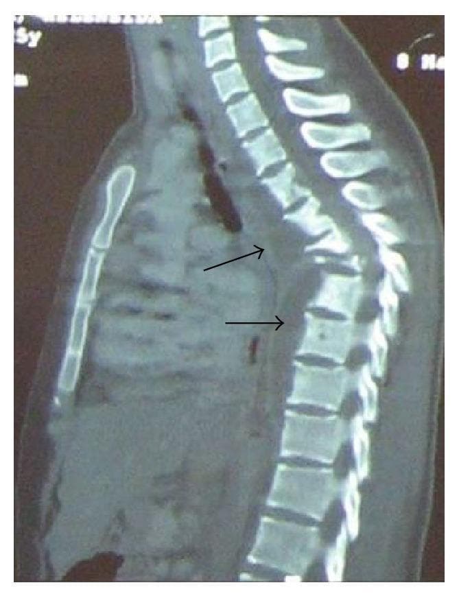 This diagnostic image is a sagittal Computed Tomography (CT) scan of the thoracic spine. It demonstrates significant osteolytic destruction of multiple mid-thoracic vertebral bodies, characteristic of spinal tuberculosis (Pott's disease). There is a prominent collapse of the anterior spinal elements leading to a severe, acute-angle kyphotic deformity (Gibbus deformity). Adjacent to the area of vertebral destruction, arrows point to a large, hypodense soft tissue mass extending along the anterior and paravertebral space, consistent with a cold abscess. The image illustrates the classic radiographic triad of spondylodiscitis: vertebral body destruction, disk space narrowing/collapse, and associated paraspinal soft tissue involvement, highlighting the risk of spinal cord compression and structural instability in advanced granulomatous infections.
