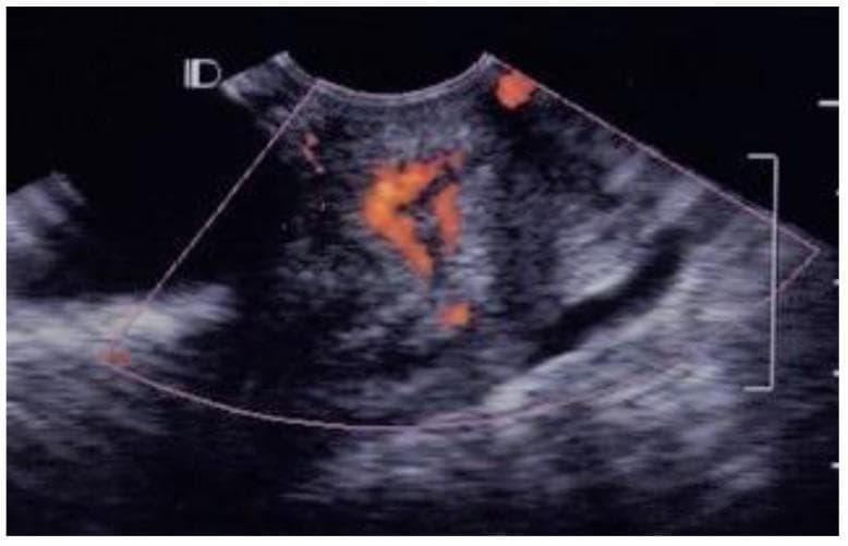 This diagnostic image is a transvaginal color Doppler ultrasound of the cervix in a 22-year-old patient with Pelvic Inflammatory Disease (PID). The image demonstrates Grade 3 cervical vascularity. The grayscale ultrasound shows a sagittal view of the cervix with heterogeneous echogenicity and a clearly visible elongated endocervical canal. The color Doppler overlay reveals multiple prominent vascular spots concentrated within the endocervical canal. These red signals indicate significant blood flow, appearing in a branching and clustered distribution rather than a diffuse pattern throughout the entire stroma. The increased vascularity within the canal is a characteristic finding of acute cervicitis and cervical hyperemia associated with inflammatory conditions. This visualization is used to assess the severity of inflammation and differentiates between simple and complex cervicitis based on the extent of angiogenesis and vessel distribution patterns.