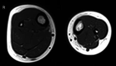This diagnostic image is an axial T1-weighted spin-echo MRI sequence (TE-11, TR-656) through the proximal segment of the lower limbs, presenting a comparative view of muscle compartment anatomy. The right leg (marked 'R') displays a normal anatomical distribution of the superficial and deep posterior muscle compartments. In contrast, the left leg demonstrates a congenital absence of the majority of the superficial posterior compartment, specifically the medial gastrocnemius and soleus muscles. A small, atrophied lateral gastrocnemius is the only visible remnant of this compartment. To compensate for the absent musculature, there is visible hypertrophy of the deep posterior compartment and the peroneal compartment muscles on the left side. This image illustrates developmental musculoskeletal anomalies and secondary compensatory muscular changes, relevant for clinical education in orthopedics, radiology, and congenital disorders.