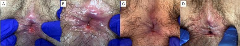 A series of four clinical photographs (a-d) showing the chronological progression and healing of a chronic anal fissure (AF) in the perianal region over a six-month period following treatment with incobotulinumtoxinA (incoBoNT/A). Frame (a) represents the baseline, showing a deep, erythematous longitudinal tear in the anoderm with associated inflammation of the surrounding perianal skin. Frame (b) shows the one-month follow-up, demonstrating a persistent fissure but with reduced surrounding erythema. Frame (c) illustrates the three-month follow-up, where the fissure size is significantly reduced and the tissue appears less irritated. Frame (d) represents the six-month follow-up, showing near-complete resolution of the fissure, restoration of skin integrity, and a healthy, non-inflamed perianal appearance. This sequence demonstrates the clinical efficacy of botulinum toxin in promoting the healing of chronic fissures by reducing internal anal sphincter hypertonicity and improving local perfusion.