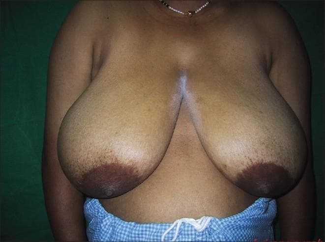 Clinical photograph of a patient with bilateral macromastia (breast hypertrophy), shown in a preoperative state for a reduction mammaplasty using an inverted T resection technique. The breasts are large and pendulous (grade III ptosis), extending significantly below the inframammary crease. The skin shows areas of hyperpigmentation and striae, particularly in the lower poles. The nipple-areola complexes are enlarged and displaced inferiorly due to the weight of the breast tissue. A vertical hypopigmented or perhaps powdered surgical marking area is visible extending from the sternal notch into the intermammary cleft. This image serves as a clinical example of severe breast hypertrophy requiring reconstructive surgery, highlighting the anatomical landmarks such as the breast meridian and nipple projection needed for surgical planning of pedicle-based resections (e.g., medial or inferior pedicle techniques).