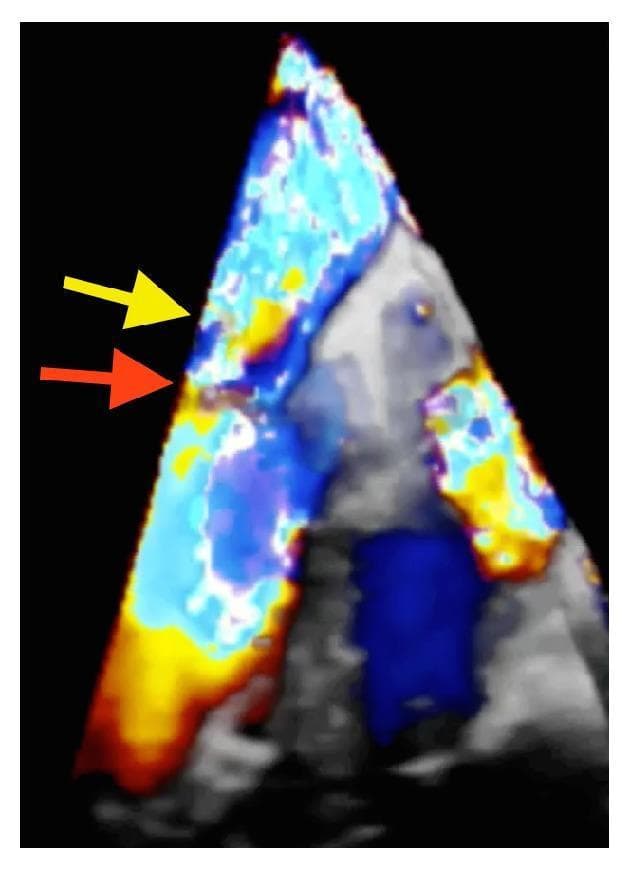 This diagnostic image is a Color 3D Transesophageal Echocardiogram (TEE) in an apical four-chamber view, demonstrating severe mitral regurgitation. The visualization combines grayscale volumetric structural data with color Doppler flow mapping to highlight hemodynamics within the left atrium. Two distinct regurgitant jets are identified: a prominent lateral jet (indicated by a red arrow) originating from a perforation in the P2 scallop of the posterior mitral leaflet, and a secondary central jet (marked by a yellow arrow). The color signals exhibit significant variegation, including shades of red, blue, and yellow, which denote high-velocity turbulent flow and aliasing typical of severe valvular insufficiency. The spatial relationship between the grayscale anatomical structures and the dynamic color signals illustrates the mechanical failure of the mitral valve apparatus, often associated with infective endocarditis and subsequent leaflet perforation. This image serves as a high-level educational example of using real-time 3D Doppler to map complex multi-jet regurgitation for surgical planning.
