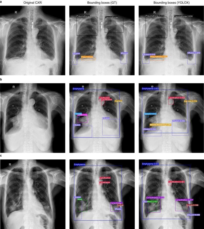 A multi-panel diagnostic image comparison displaying three clinical cases (a, b, c) of posterior-anterior (PA) chest X-rays (CXRs). The image is organized into three columns for each case: 'Original CXR', 'Bounding boxes (GT)' representing the ground truth expert annotations, and 'Bounding boxes (YOLOX)' showing deep learning model predictions with confidence scores. Case (a) demonstrates bilateral apical pneumothorax and basilar pleural effusions. Case (b) illustrates complex pathology including emphysema, aortic arch calcification, a rib fracture, fibrosis, and pleural thickening. Case (c) shows a large pulmonary mass/consolidation in the right lower lobe, emphysema, and calcification. The color-coded bounding boxes categorize 14 different chest abnormalities, including effusion, pneumothorax, consolidation, and mass. This comparison serves as an educational tool for artificial intelligence in radiology, highlighting the model's ability to localize and identify multi-focal pathology while also demonstrating discrepancies such as missed small calcifications or additional diagnoses not in the ground truth.