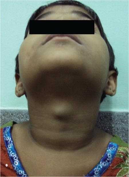 Clinical photograph of a pediatric patient's neck, viewed from an inferior-anterior perspective (looking up toward the chin). The image demonstrates a prominent, well-circumscribed, midline cystic swelling in the anterior neck, located superior to the thyroid cartilage. The overlying skin appears normal with no visible erythema, inflammation, or ulceration. The morphology is characteristic of a thyroglossal duct cyst, a common congenital abnormality occurring along the descent pathway of the thyroid gland. In this clinical context, such a mass often contains ectopic functional thyroid tissue and typically moves upward upon protrusion of the tongue or swallowing. The visual findings illustrate a classic presentation of a midline neck mass in childhood, serving as an educational example for differential diagnosis in pediatric otolaryngology and endocrinology, specifically regarding ectopic thyroid tissue and thyroglossal duct remnants.