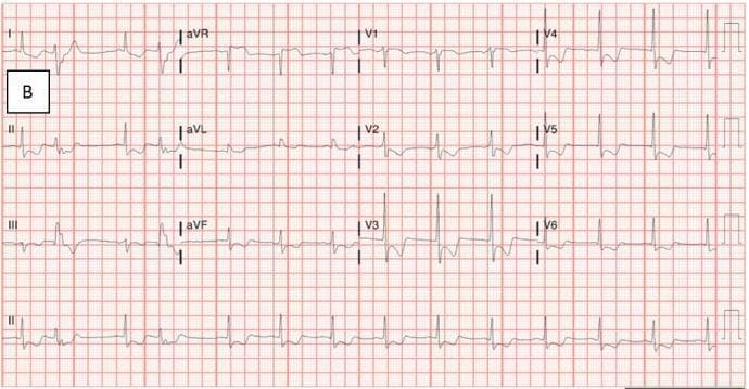 A standard 12-lead electrocardiogram (ECG) tracing on a red grid background, demonstrating significant electrophysiological abnormalities. The rhythm is sinus, but the tracing exhibits diffuse ST-segment depression prominently visible in the precordial leads (V2-V6) and limb leads (I, II, aVL), which is highly indicative of severe global subendocardial ischemia. Conversely, localized ST-segment elevation is noted in lead aVR (and to a lesser extent in aVF), a pattern often associated with left main coronary artery occlusion or multi-vessel disease. Temporal measurements show shortened PR intervals and noticeably prolonged QT intervals. This diagnostic image serves as a critical educational tool for identifying ischemic patterns, electrolyte imbalances, or acute coronary syndromes in cardiovascular medicine and emergency triage training.