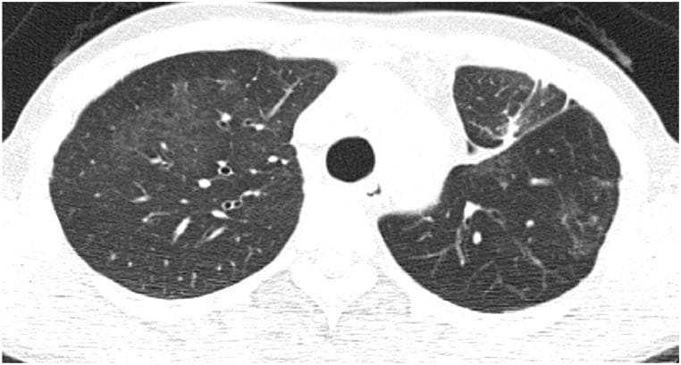 This diagnostic axial chest CT scan demonstrates diffuse pulmonary parenchymal abnormalities characteristic of hypersensitivity pneumonitis, specifically 'humidifier lung.' The image reveals bilateral, though asymmetric, mosaic attenuation. The left lung exhibits extensive, ill-defined centrilobular ground-glass nodules and hazy increased density. Within these regions of ground-glass opacity, small, lucent, cystic-like structures are visible, representing dilated bronchioles or air trapping. In contrast, the right lung shows a more heterogeneous pattern, with patches of normal-attenuating lung interspersed with areas of subtly increased density. The distribution of these findings is predominantly centrilobular, typical of small airway involvement and granulomatous inflammation following organic antigen exposure. This CT illustrates key features used in differentiating acute or subacute hypersensitivity pneumonitis from other interstitial lung diseases, highlighting the importance of recognizing mosaic perfusion and ground-glass patterns in the clinical context of recurrent pneumonia.