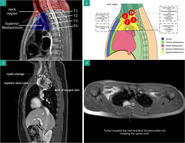 A four-panel medical figure illustrating the surgical anatomy and diagnostic imaging of superior mediastinal masses.
Panel 1: A sagittal T2-weighted magnetic resonance imaging (MRI) view highlighting the superior mediastinum (shaded blue) and its anatomical boundaries, specifically the region between the thoracic inlet and the T4-T5 intervertebral disc level.
Panel 2: A schematic diagram color-coded by mediastinal compartments (anterior, middle, posterior, and superior) showing the distribution and pathological types of identified lesions, including schwannoma, ganglioneuroma, bronchogenic cyst, and cavernous hemangioma.
Panel 3: A sagittal contrast-enhanced MRI demonstrating a large heterogeneous mass in the superior mediastinum with cystic changes. The image labels its close proximity to the superior vena cava and the arch of the azygos vein.
Panel 4: An axial MRI slice showing a tumor invading the intervertebral foramen. The annotation notes that while the tumor occupies the neural foramen, it does not invade the spinal cord.
This collection is used to teach preoperative assessment of neurovascular involvement and resectability of mediastinal tumors using the da Vinci robotic surgical system.