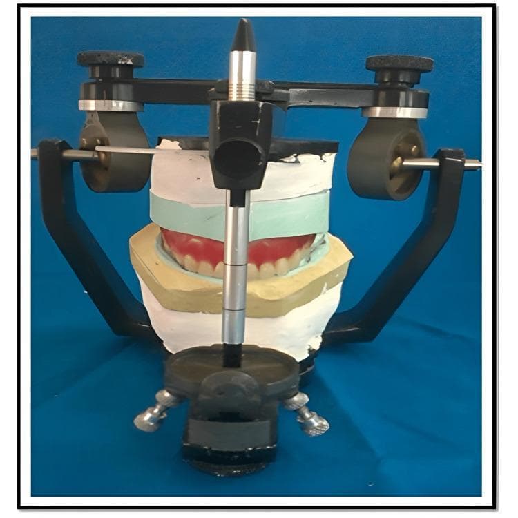 This procedural image illustrates a semi-adjustable dental articulator (Hanau type) used in the fabrication of a removable prosthesis. The device houses a stone core assembly consisting of multiple dental plaster and stone layers. A trial denture, featuring white artificial teeth set in a red wax-up gingiva, is sandwiched between these layers. The layered structure comprises a white maxillary mounting stone, a light-green stone layer, and a yellow Type III dental stone base. A vertically oriented metal incisal pin with adjustable markings is visible at the midline to maintain and verify the established vertical dimension of occlusion. The articulator's mechanical components, including the condylar elements and U-shaped frame, facilitate the replication of mandibular movements such as centric, protrusive, and lateral excursions. This setup is specifically used for the functionally generated path technique, where the stone core represents the recorded movements of the opposing arch to ensure balanced occlusion and eliminate interferences during the try-in phase.