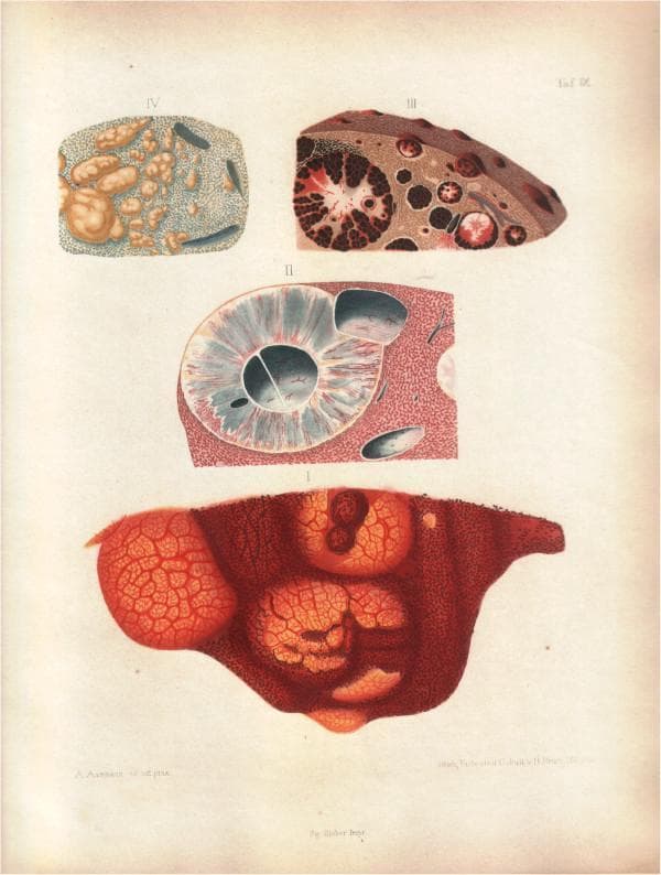 A historical medical illustration consisting of four numbered anatomical drawings (I-IV) by Friedrich Theodor von Frerichs, depicting the gross and microscopic deposition of malarial pigment (hemozoin) in human internal organs. Section I shows a reddish-brown organ (likely liver) with a lobular architecture and dark, reticular staining patterns. Section II illustrates a cross-section of a layered structure, possibly an eye or blood vessel, showing central dark pigmentation and peripheral radiating lines. Section III displays a brown-pigmented organ section containing multiple circular inclusions; these structures exhibit a combination of black pigment arranged in concentric patterns and lighter reddish areas, representing the accumulation of hematin-derived crystals in tissue. Section IV presents a microscopic view of light gray tissue with scattered, irregular, dark-staining oval structures and brown inclusions. The plate serves as an early pathological study of how malaria affects systemic organs through the deposition of breakdown products from erythrocytes, supporting the 19th-century transition toward understanding malaria as a hematological disease.