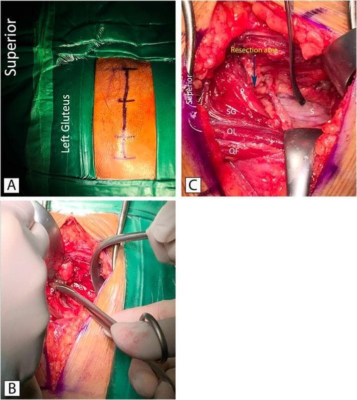 This composite of three intraoperative clinical photographs demonstrates the surgical management of piriformis syndrome via decompression of the sciatic nerve. Panel A shows preoperative planning with the patient in a prone position; a linear incision marking is visible on the left gluteal region, oriented longitudinally relative to the superior-inferior axis. Panel B captures the initial surgical exposure using metallic retractors to separate subcutaneous tissue and gluteal fibers, revealing the piriformis muscle (labeled 'P'). Panel C provides a detailed anatomical view of the deep gluteal space following partial resection of the piriformis. Key structures identified include the piriformis muscle (P), superior gemellus (SG), obturator internus (OI), and quadratus femoris (QF). The sciatic nerve (labeled 'S') is shown as a thick, whitish cord-like structure positioned deep to the piriformis and superficial to the other short external rotators. An arrow indicates the 'resection area' of the piriformis muscle where it previously compressed the nerve. This figure serves as an educational resource for identifying deep gluteal anatomy and understanding the decompression technique for sciatic nerve entrapment.