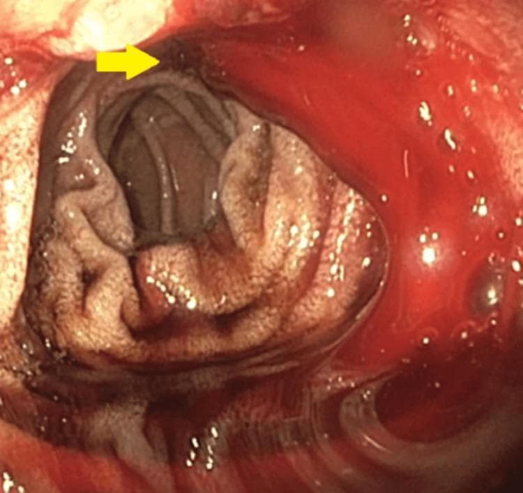 This endoscopic image (Esophagogastroduodenoscopy) provides a view of the duodenal bulb and proximal duodenum. A yellow arrow points to a cratered duodenal ulcer located on the mucosal wall. The ulcer exhibits stigmata of active hemorrhage, specifically a slow, consistent oozing of liquid, dark red blood into the duodenal lumen, characteristic of a Forrest Class Ib ulcer. The surrounding duodenal mucosa appears erythematous and edematous. This visual serves as a clinical example of an upper gastrointestinal bleed (UGIB) originating from peptic ulcer disease. The image is intended for medical training in gastroenterology, focusing on the endoscopic identification, classification, and assessment of bleeding risk in peptic ulcers.