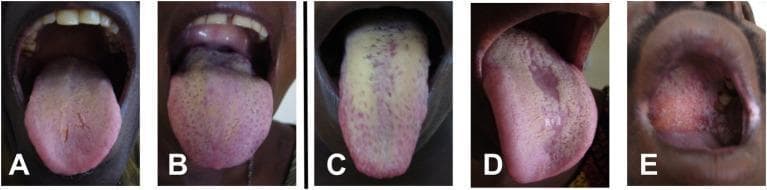 A compilation of five clinical intraoral photographs (A–E) illustrating various presentations of oral candidiasis. Images A and B demonstrate mild involvement, characterized by thin yellowish-white coatings on the dorsal tongue covering less than 50% of the surface area. Image C displays a more severe case of pseudomembranous candidiasis, with thick, confluent whitish-yellow plaques covering over 50% of the tongue's dorsal surface. Image D shows median rhomboid glossitis, appearing as a well-defined, erythematous, atrophic area along the midline of the tongue, where filiform papillae are absent, surrounded by light peripheral plaques. Image E depicts palatal involvement, showing a diffuse erythematous area with granular texture and small inflammatory lesions on the hard and soft palate. This series is used for the clinical classification of oral fungal infections, often seen in immunocompromised patients, such as those with HIV/AIDS, and demonstrates the spectrum from mild yeast colonization to severe acute thrush and atrophic mucosal changes.