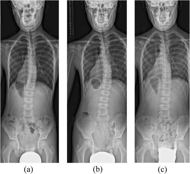 This composite diagnostic image features three posteroanterior (PA) whole-spine radiographs (labeled a, b, and c) of a pediatric patient, demonstrating the progression and management of scoliosis during brace treatment. Radiograph (a) shows a right-convex (leftward) scoliotic curve in the mid-thoracic region at 3 months of treatment, notable for a curve reversal from the initial presentation. Radiograph (b) illustrates a progression of this right-convex curvature at 7 months, with increased vertebral deviation and apical translation. Radiograph (c) displays the spine at 15 months following brace adjustment, showing improved coronal alignment and a reduction in the Cobb angle. Throughout the series, the images provide a comparison of vertebral alignment, rib cage symmetry, and pelvic levelness. This series is an educational example of monitoring idiopathic scoliosis, assessing bracing efficacy, and managing curve overcorrection or reversal in a growing child. It highlights key radiological concepts including Cobb angle measurement, spinal convexity, and longitudinal follow-up in orthopedic pediatrics.