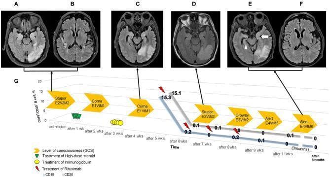 Educational infographic illustrating the clinical course of autoimmune encephalitis through a longitudinal timeline and corresponding neuroimaging. Panels A-F show axial T2-FLAIR brain MRI images at different stages. Initial images (A, B) demonstrate significant hyperintensity and swelling (edema) in the hippocampi, temporal cortex, thalami, and parietal lobes. Intermediate and follow-up images (C-F) show the regression of these lesions following immunotherapy. Panel E highlights residual hyperintensity and evolving atrophy in the medial temporal lobes, indicated by a white arrow (left) and arrowhead (right). Panel G presents a timeline over five months, correlating Glasgow Coma Scale (GCS) scores with treatment interventions—including high-dose steroids (green triangles), IVIg (yellow circles), and Rituximab (red lightning bolts)—and CD19+/CD20+ B-cell counts. The graph visualizes the depletion of B-cells following Rituximab administration and the subsequent improvement in the patient's neurological status from coma/stupor to an alert state.