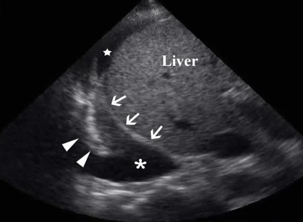 This diagnostic ultrasound image demonstrates a focused assessment of the right upper quadrant and thorax, commonly utilized in Focused Assessment with Sonography for Trauma (FAST) exams. The scan reveals a large anechoic to hypoechoic pleural collection (indicated by an asterisk) located superior to the diaphragm (delineated by white arrows). Within the pleural fluid, a collapsed right lower lung lobe is visible (marked by arrowheads), presenting with a tissue-like echogenicity relative to the surrounding effusion. The liver is visualized inferior to the diaphragm, showing typical parenchymal echotexture. Additionally, a smaller pocket of free anechoic intra-abdominal fluid (marked by a white star) is seen adjacent to the liver surface. This finding is clinically significant for the simultaneous detection of hemothorax and hemoperitoneum in a trauma setting, illustrating the utility of ultrasound in identifying pathological fluid across the diaphragmatic interface.