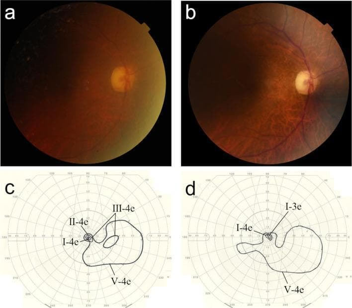 This composite educational graphic displays a comparison of ophthalmic findings for a right eye at two different time points. Panels (a) and (b) are color fundus photographs. Image (a) shows a hazy view of the posterior pole with poor definition of the optic nerve head and retinal vasculature, consistent with media opacity from endophthalmitis. Image (b) shows improved clarity at the final follow-up, revealing a clear optic disc and better visualization of the macula and retinal vessels. Panels (c) and (d) present Goldmann kinetic perimetry (visual field) results. Image (c) illustrates the initial visual field with multiple isopters (I-4e, II-4e, III-4e, and V-4e), showing a central scotoma and moderate peripheral constriction. Image (d) shows the final visual field with isopters I-4e, I-3e, and V-4e; while the III-4e isopter is absent and the field remains constricted, the overall sensitivity indicates functional preservation of vision. These images demonstrate the longitudinal management of glaucoma and infection, highlighting that despite complications like intraocular pressure fluctuations, key anatomical and functional markers were maintained.