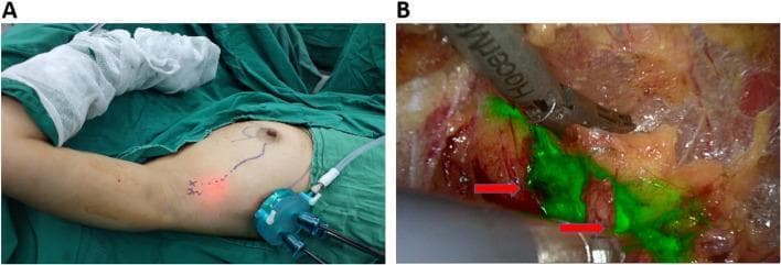 Clinical and endoscopic photographs demonstrating axillary sentinel lymph node biopsy (SLNB) using near-infrared (NIR) fluorescence. Panel A shows the external surgical field with the patient in a supine position, arm abducted. A single-pore endoscopic retractor is inserted through a midaxillary incision. Surface markings indicate the projected lymphatic drainage pathway and the location of the sentinel lymph node (SLN), guided by indocyanine green (ICG). Panel B provides an intraoperative NIR endoscopic view of the axillary dissection. Sentinel lymph nodes and connecting lymphatic vessels are clearly visualized as bright green fluorescent structures (red arrows) against the background of red muscular tissue and yellowish-white adipose and connective tissue. Surgical instruments are seen manipulating the tissue to isolate the fluorescent nodes. This technique illustrates the use of real-time ICG-fluorescence guidance for accurate SLN identification and minimally invasive resection in early breast cancer management.