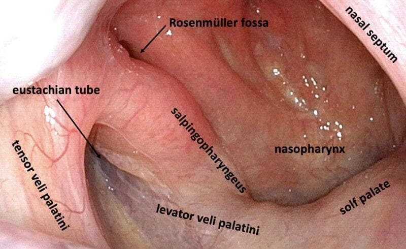 This clinical diagnostic image is a high-definition endoscopic view of the right lateral nasopharynx in a healthy adult. The image clearly demonstrates the anatomical landmarks of the pharyngeal orifice of the Eustachian tube. Key structures labeled include the Eustachian tube opening appearing as a dark slit, the Rosenmüller fossa (pharyngeal recess) located posteriorly, and the torus tubarius. The muscular anatomy is delineated, showing the tensor veli palatini anteriorly and the levator veli palatini inferiorly. The salpingopharyngeus muscle is visible as a vertical fold of mucosa. Other landmarks include the soft palate forming the inferior boundary, the nasopharyngeal wall, and the posterior edge of the nasal septum. The mucosa appears healthy, pink, and well-vascularized without signs of inflammation, lymphoid hyperplasia, or obstruction. This image serves as a reference for normal nasopharyngeal anatomy and the study of peritubal muscle relationships relevant to Middle Ear Myoclonus (MEM) and Eustachian tube dysfunction.