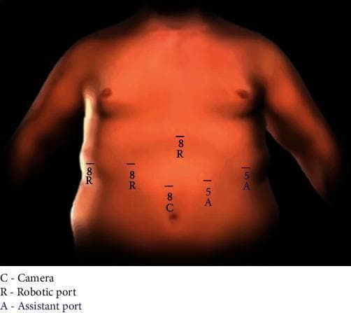 This medical illustration depicts the standard abdominal port placement for a robotic-assisted cholecystectomy on a human torso. The diagram highlights six specific surgical access points: three robotic arm ports (labeled '8 R'), one robotic camera port (labeled '8 C'), and two laparoscopic assistant ports (labeled '5 A'). The camera port 'C' is positioned supraumbilical in the midline. The robotic ports 'R' are distributed across the upper quadrants: one in the epigastrium and two in the right lateral and right mid-abdominal regions. The assistant ports 'A' are located in the left mid-abdominal and left lower quadrant regions. Numerical prefixes (8 and 5) indicate the port size in millimeters. This diagram serves as a clinical guide for surgeons to optimize robotic arm range of motion and assistant access during gallbladder removal, particularly in patients with complex surgical histories or significant inflammation as seen in acute cholecystitis.