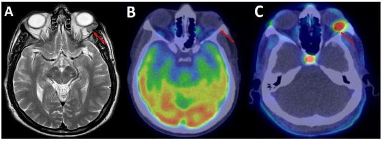 This diagnostic comparison image consists of three axial head scans (A, B, and C) illustrating a left supraorbital solitary fibrous tumor (SFT) recurrence in a 69-year-old male. Panel A is a T2-weighted contrast-enhanced MRI (T2c+) showing a small, rounded soft tissue lesion on the lateral aspect of the left orbit (red arrow). Panel B is an 18F-FDG PET/CT scan which demonstrates no significant radiopharmaceutical uptake at the lesion site (red arrow), obscured by the high physiological metabolic activity of the surrounding brain parenchyma. Panel C is an 18F-fluorocholine (18F-FCH) PET/CT scan, which reveals intense focal radiopharmaceutical uptake (SUVmax 6.8) in the same supraorbital lesion (red arrow). The series demonstrates the clinical utility of 18F-FCH PET/CT over 18F-FDG PET/CT for detecting certain mesenchymal tumors like SFTs, highlighting its superior tumor-to-background ratio due to low physiological choline uptake in normal brain tissue. This comparison is essential for understanding advanced oncological imaging in neuro-ophthalmology and radiology.