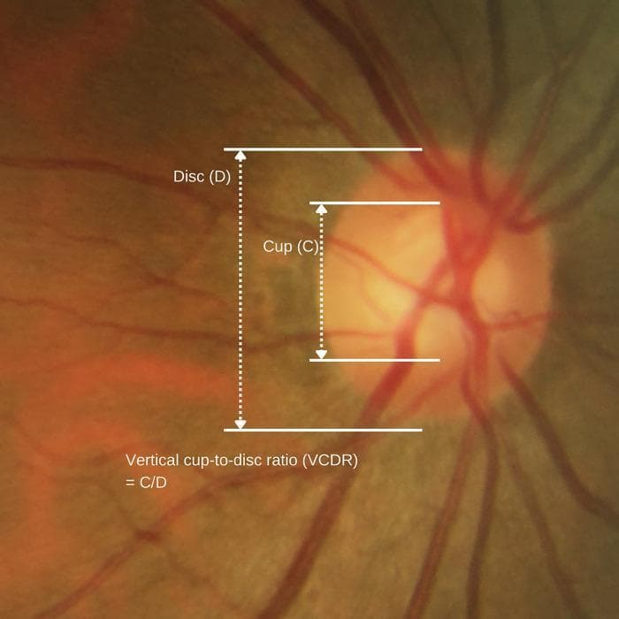 This clinical fundus photograph illustrates the anatomy of the optic nerve head (ONH) and the method for calculating the vertical cup-to-disc ratio (VCDR), a critical metric in glaucoma screening. The image displays a yellowish-orange optic disc with a centralized, lighter-colored depression known as the optic cup. Retinal blood vessels are seen emerging from the center of the cup and radiating across the fundus. Superimposed on the image are white measurement markers: a long vertical dotted line labeled 'Disc (D)' spans the entire vertical diameter of the optic disc, and a shorter vertical dotted line labeled 'Cup (C)' measures the vertical diameter of the cup. The formula 'Vertical cup-to-disc ratio (VCDR) = C/D' is provided to define the relationship between these two measurements. This educational diagram is used to teach medical students and clinicians how to assess optic nerve cupping, where a VCDR ≥ 0.8 is typically considered pathological and suggestive of glaucomatous nerve damage and neuroretinal rim thinning.