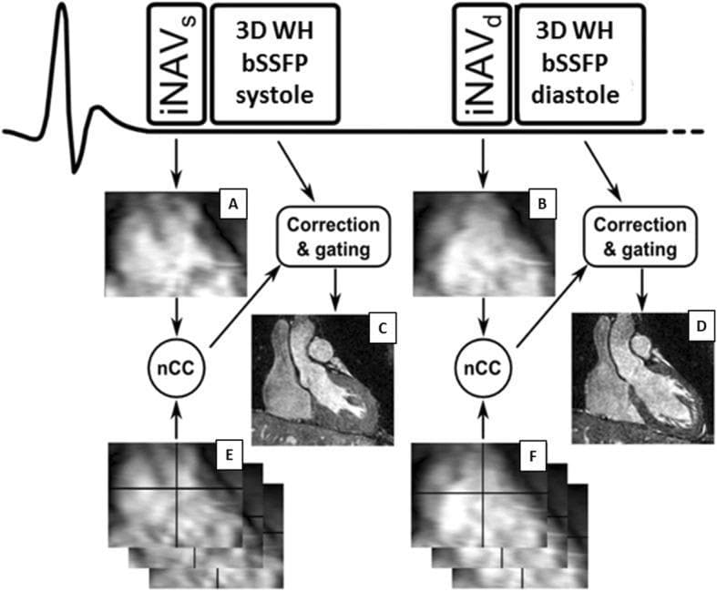 This medical schematic illustrates the workflow for dual-phase, 3D Whole-Heart (WH) balanced Steady-State Free Precession (bSSFP) cardiac magnetic resonance imaging (MRI) using image navigator (iNAV) respiratory motion correction. The diagram displays two parallel pathways synchronized with an electrocardiogram (ECG) trace for the systolic and diastolic phases.
In the systolic branch (left), the sequence initiates with a systolic image navigator (iNAV_s) and subsequent 3D WH bSSFP acquisition. The initial iNAV serves as a reference (Image A). Subsequent systolic iNAVs (Image E) are registered to the reference using normalized cross-correlation (nCC). This data informs the 'Correction & gating' block, which processes the raw bSSFP data to produce a motion-corrected systolic reconstruction (Image C).
The diastolic branch (right) follows a mirrored protocol starting with iNAV_d and 3D WH bSSFP diastole data. Diastolic reference iNAVs (Image B) and subsequent frames (Image F) undergo nCC registration and respiratory gating to generate the final diastolic reconstruction (Image D). The process demonstrates real-time translational motion correction and respiratory gating for high-resolution cardiac morphology imaging.