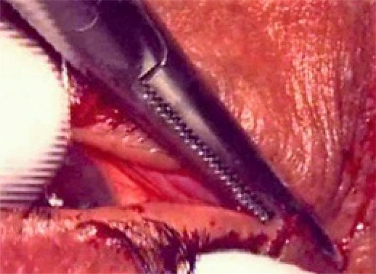 This clinical photograph captures a close-up view of an ophthalmic surgical procedure, specifically a lateral canthotomy. The image demonstrates a metallic surgical instrument, appearing as a dark-colored hemostatic clamp or forceps with distinctive serrated jaws, applied to the lateral canthus of the eye. The instrument is compressing the tissue at the junction of the upper and lower eyelids to achieve hemostasis before a lateral cantholysis or incision. The surrounding periocular tissue is erythematous and moist, with visible anatomical landmarks including the eyelid margins and eyelashes. Minimal surgical bleeding is present in the operative field. This visual serves as an educational example of the initial stages of a lateral canthotomy, a critical procedure for managing orbital compartment syndrome by decompressing the orbit. The focus is on the correct placement and application of surgical instruments to the lateral palpebral ligament area.