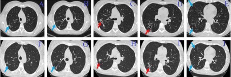 This Comparison Chart displays ten axial chest CT scan slices from a patient with a pulmonary Mycobacterium abscessus infection, illustrating disease progression and treatment response. Panels A-E (top row) represent pre-treatment baseline imaging, while panels F-J (bottom row) show the same anatomical levels following the initial phase of medical therapy. The pre-treatment scans (A-E) demonstrate multiple active pathologies: large thick-walled pulmonary cavities in the right lung (indicated by red arrows in panels C and D) and extensive bilateral 'tree-in-bud' opacities (indicated by blue arrows), which represent centrilobular nodules and branching linear structures characteristic of small-airway impaction and endobronchial spread of infection. In the post-treatment scans (F-J), there is a visible radiological improvement characterized by a significant reduction in the size and wall thickness of the cavities (red arrows in H and I) and a marked decrease in the density and distribution of the tree-in-bud lesions (blue arrows). The image serves as a clinical illustration of antibiotic efficacy in treating nontuberculous mycobacteria (NTM) lung disease, specifically highlighting the resolution of bronchogenic spread and cavitary lesions.