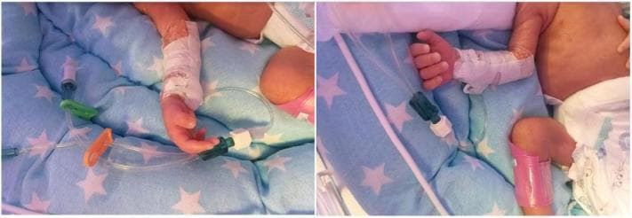 Content Type: Clinical Photograph (procedural). This image depicts a neonatal Peripherally Inserted Central Catheter (PICC) placement in a preterm infant. The photograph shows the infant's forearm with a catheter inserted into the basilic vein. The insertion site is secured with a specialized, non-woven white IV fixing bandage and covered by a clear transparent dressing to allow for site monitoring. The distal end of the Arrowg+ard Blue Advance™ PICC is visible exiting the bandage, connected to multiple IV administration set components, including clear lumen tubing with green and orange needleless connectors/ports. The infant is positioned on a blue patterned blanket within a Neonatal Intensive Care Unit (NICU) setting. This visual illustrates the standard procedural fixation and external assembly of a PICC line for long-term intravenous access in neonates requiring intensive care for conditions such as respiratory distress or preterm complications.