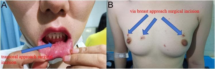 This clinical photograph set displays postoperative outcomes one month after endoscopic thyroid surgery using two distinct minimally invasive techniques. Panel A illustrates the transoral approach, showing a horizontal linear scar on the internal mucosal surface of the lower lip, positioned below the teeth and above the labial frenulum. Panel B depicts the breast approach, showing three small, symmetrical surgical incisions on the chest wall. Two incisions are located superior-laterally to each nipple, with a third central incision positioned between the breasts in the parasternal region. The images demonstrate the cosmetic advantages of extracervical approaches in thyroidectomy, specifically the Transoral Endoscopic Thyroidectomy Vestibular Approach (TOETVA) and the Breast Approach, which avoid visible scarring on the neck. These visuals serve as educational material for surgical oncology and endocrine surgery regarding patient aesthetic outcomes and port placement in remote-access thyroid surgery.