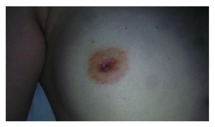 This clinical photograph shows a close-up view of a female right breast, primarily demonstrating nipple retraction (inversion). The nipple is clearly pulled inward into the breast tissue rather than projecting normally. The surrounding areola appears hyperpigmented (darker in color) relative to the adjacent skin but maintains a circular, regular border. The surrounding breast skin appears intact without visible erythema (redness), edema (swelling), Peau d'orange texture, or ulceration. There is no evidence of active nipple discharge or inflammatory changes on the skin surface. This finding is a significant clinical sign in breast pathology, often associated with underlying masses or architectural distortion, requiring diagnostic imaging such as ultrasound or mammography to rule out malignancy or benign fibroepithelial lesions.