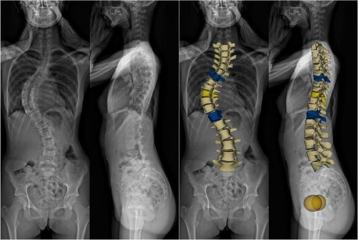 Full-body EOS imaging and corresponding 3D digital reconstructions of a 16-year-old female patient diagnosed with Adolescent Idiopathic Scoliosis (AIS). The image set includes coronal (anterior-posterior) and sagittal (lateral) views. The coronal view demonstrates a significant 'S'-shaped lateral spinal curvature characterized by a 67-degree Cobb angle. The primary thoracic curve exhibits a rightward convexity, while the lumbar region shows a compensatory leftward convexity, classified as Lenke 1AN. The 3D models highlight vertebral rotation, specifically shifting the spinous processes toward the concavity of the curves. In the sagittal view, there is a visible reduction in normal thoracic kyphosis and an altered lumbar lordosis, accompanied by a posterior pelvic tilt. These diagnostic images illustrate the complex three-dimensional deformity of the spine, showing the relationship between coronal malalignment, sagittal profile changes, and pelvic compensation in scoliosis management.