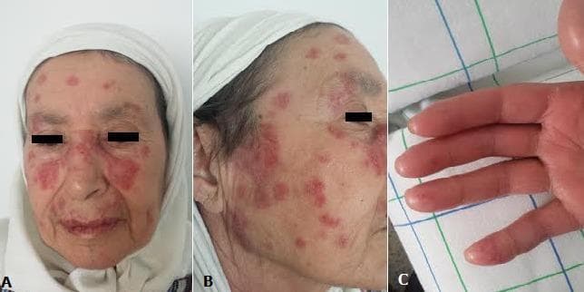 A composite of clinical photographs demonstrating dermatological manifestations suggestive of systemic autoimmune disease, likely Systemic Lupus Erythematosus (SLE). Panel A shows a frontal view of the face with well-demarcated, erythematous, squamous plaques in a malar 'butterfly' distribution across the bridge of the nose and cheeks, sparing the nasolabial folds. Additional discrete discoid-like lesions are visible on the forehead. Panel B presents a lateral view showing multifocal, erythematous, scaly plaques scattered across the cheek and temple areas. Panel C displays the palmar surface of the hand, illustrating digital pulpitis characterized by erythematous, swollen, and shiny fingertips with evidence of localized inflammation and edema. The clinical findings represent classic mucocutaneous involvement, including malar rash and digital vasculopathy, serving as important diagnostic markers in rheumatological and dermatological evaluations for connective tissue disorders.