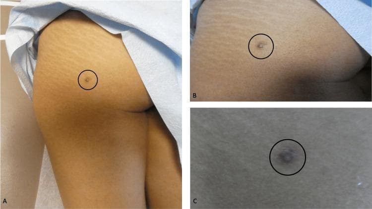 Clinical photograph series (distant, medium, and close-up views) depicting a dermatofibroma on the left buttock of a 42-year-old female. The lesion consists of a central, well-circumscribed, brown-colored dermal nodule measuring approximately 1.2 x 1.2 cm. This nodule is protuberant and elevated above the skin surface. Surrounding the central nodule is a larger, ill-defined, hyperpigmented patch measuring approximately 3 x 2 cm, which displays irregular borders and a diffuse, tan-to-brown discoloration compared to the adjacent normal skin. The surrounding skin exhibits normal anatomical features, including visible striae distensae in the superior and lateral aspects. The central nodule is marked with a black circle across all three panels (A, B, and C) for localization. This visual presentation is characteristic of a benign fibrous histiocytoma (dermatofibroma), highlighting the common morphological features of firm, raised dermal nodules with associated peripheral hyperpigmentation, frequently found on the extremities or trunk.
