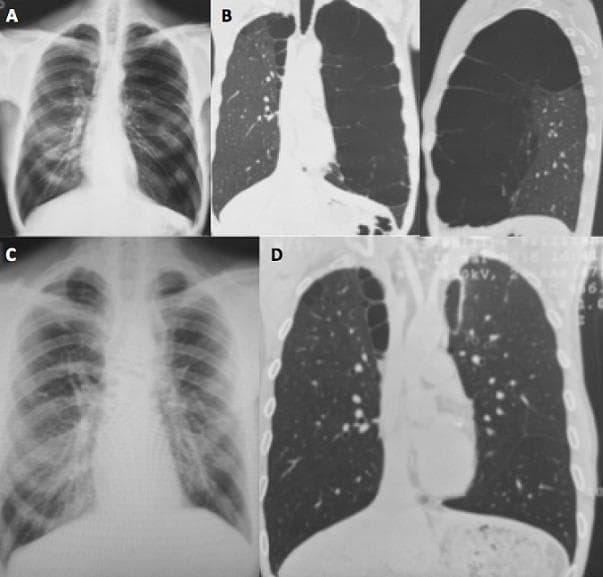 A multi-panel medical comparison chart displaying preoperative and postoperative imaging of a patient with giant bullous emphysema. Panels A and B present preoperative findings. Panel A is a posterior-anterior chest X-ray showing significant left-sided pulmonary hyperlucency and mediastinal shift. Panel B consists of coronal and sagittal chest CT views revealing a giant, thin-walled emphysematous bulla with internal septations replacing nearly the entire left upper lobe and compressing adjacent lung parenchyma. Panels C and D present postoperative findings following a thoracoscopic bullectomy. Panel C is a postoperative chest X-ray demonstrating complete pulmonary expansion and resolution of the previously seen hyperlucency. Panel D is a coronal chest CT confirming successful resection of the bulla, improved left lung volume, and more uniform parenchymal density. This clinical comparison illustrates the surgical management of vanishing lung syndrome and the radiographic restoration of lung architecture.