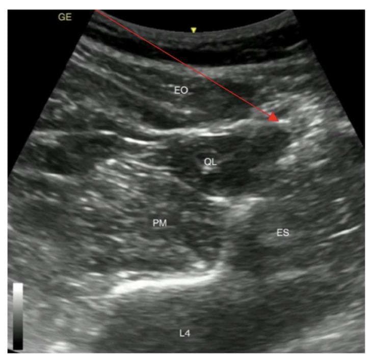 This diagnostic ultrasound image demonstrates the regional anatomy for a posterior Quadratus Lumborum Block (QLB type 2). The sonogram shows a transverse view of the abdominal wall and paraspinal musculature at the level of the fourth lumbar vertebra (L4). Key anatomical structures are labeled, including the superficial external oblique (EO) muscle, the quadratus lumborum (QL) muscle, the psoas major (PM) muscle situated anteriorly, and the erector spinae (ES) muscle group located posteriorly. The hyperechoic shadow of the L4 vertebral body serves as a deep posterior landmark. A yellow arrow identifies the patient's skin surface. A red arrow illustrates the planned needle trajectory for a posterior QLB, originating from the skin, traversing the EO, and targeting the interfacial plane on the posterior aspect of the QL muscle (the 'shamrock sign' area). This image is an essential educational resource for regional anesthesia, illustrating the sonographic landmarks required for safe and effective truncal nerve blocks.