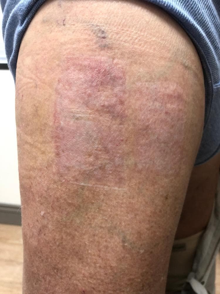 Clinical photograph of a 73-year-old male's right thigh demonstrating a well-healed split-thickness skin graft donor site. The donor site is a clearly demarcated, rectangular area characterized by a reddish-pink hue that contrasts with the surrounding tan-colored, sun-damaged skin. The texture of the graft site is slightly raised and smooth with a subtle reticular pattern, indicating a resolved state following previous bullous eruptions. The surrounding skin shows signs of chronological aging and actinic damage, including solar lentigines, fine rhytides, and scattered areas of hyperpigmentation and ecchymosis. This image illustrates the clinical appearance of a donor site following successful treatment of bullous pemphigoid (BP) lesions that had emerged as an isomorphic response (Koebner phenomenon) to surgical trauma. The visual focus is on the complete resolution of tense bullae and the preservation of the rectangular donor site borders without active inflammation or blistering.