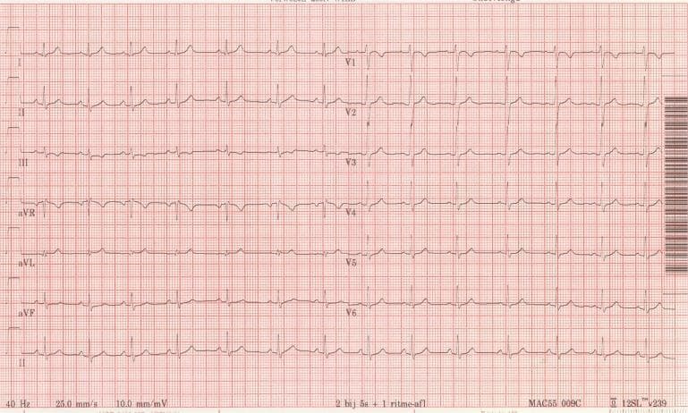 This diagnostic image shows a standard 12-lead electrocardiogram (ECG) printed on red-grid thermal paper. The recording displays limb leads (I, II, III), augmented vector leads (aVR, aVL, aVF), and precordial leads (V1-V6), accompanied by a continuous rhythm strip of Lead II at the bottom. The tracing demonstrates a normal sinus rhythm with consistent P-wave morphology preceding each QRS complex, followed by regular T-waves. All intervals, including the PR and QT intervals, appear within physiological limits for a healthy human heart. Lead V1 shows a typical small r-wave with a larger S-wave, while V6 demonstrates a dominant R-wave, indicating normal R-wave progression across the precordial leads. Technical parameters visible at the bottom of the strip indicate a standard sweep speed of 25.0 mm/s and a voltage calibration of 10.0 mm/mV. This ECG is presented as a reference for correct lead placement and normal electrical conduction after correcting previous technical errors.