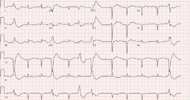 This diagnostic image is a 12-lead electrocardiogram (ECG) demonstrating an acute inferior ST-elevation myocardial infarction (STEMI). The tracing reveals a wide QRS rhythm with occasional premature ventricular complexes (PVCs). Significant ST-segment elevation is evident in the inferior leads (II, III, and aVF), characterized by a convex upward morphology merging into the T waves. Simultaneously, reciprocal ST-segment depression is visible in the anteroseptal leads (V1-V3) and lead aVL. The QRS complexes exhibit increased duration, suggesting a significant intraventricular conduction delay or bundle branch block pattern. There is poor R-wave progression across the precordial leads, and T-wave abnormalities, including flattening and inversions, are present. This ECG is representative of acute myocardial ischemia following cardiac arrest, localized to the territory of the right coronary artery (RCA) or left circumflex artery, and serves as a critical educational example of primary ST-elevation with corresponding reciprocal changes.