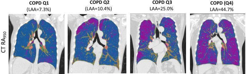 This diagnostic image series presents four coronal chest CT scans illustrating emphysema quantification in patients with varying severity of Chronic Obstructive Pulmonary Disease (COPD). The quantification is based on the RA950 metric (relative area of CT density histogram voxels < -950 HU), which identifies Low Attenuation Areas (LAA) characteristic of emphysematous tissue. A color-coded overlay is used to differentiate tissue types: healthy lung parenchyma is represented in blue, while emphysematous regions are highlighted in purple. The four panels (labeled Q1 through Q4) demonstrate a progressive increase in LAA percentage, ranging from 7.3% in early-stage disease to 44.7% in advanced emphysema. Visually, the purple areas transition from sparse focal distributions in Q1 to widespread, confluent regions in Q4, often appearing more prominent in the upper lung zones. Central mediastinal and hilar structures are visible, with some orange/red markers indicating vascular or hilar regions. This comparison chart serves as an educational tool for understanding radiological progression and automated volumetric quantification of lung destruction in COPD patients.
