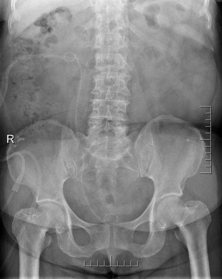This diagnostic image is a postoperative anteroposterior (AP) Kidney, Ureter, and Bladder (KUB) radiograph of the abdomen and pelvis. The skeletal anatomy, including the lumbar vertebrae, pelvic girdle, and proximal femurs, is clearly visualized. Two radiopaque medical devices are visible in the right hemiabdomen: a nephrostomy tube and a double J (DJ) ureteral stent. The nephrostomy tube enters from the right flank, with its pigtail distal end positioned within the renal pelvis region. The double J stent is seen with its superior curl in the right kidney and its inferior curl residing in the pelvic cavity, corresponding to the anatomical location of the urinary bladder. An 'R' marker is positioned on the left side of the film, indicating the patient's right side. This image demonstrates successful placement of urinary diversion and drainage devices following a surgical intervention such as percutaneous nephrolithotomy (PCNL) or cyst unroofing. The bowel gas pattern appears normal, and there are no large radiopaque calculi visible in this postoperative view.