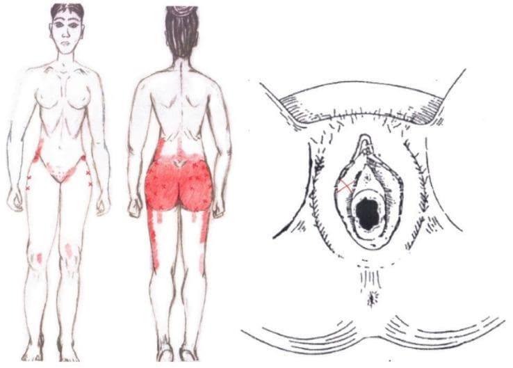 This medical illustration presents a graphical simulation of referred pain patterns associated with the gluteus medius muscle in a female subject. The image consists of two primary components: anatomical body maps (anterior and posterior views) and a detailed perineal diagram. On the body maps, referred pain is indicated by red shaded regions and 'x' markers. Posteriorly, the pain is concentrated over the gluteal region, extending superiorly to the iliac crest and inferiorly along the posterior and lateral thigh. Anteriorly, pain zones are mapped to the inguinal area, the lateral hip (greater trochanter region), and the anterior-medial knee. A detailed anatomical diagram of the vulva on the right includes an 'x' mark superior to the vaginal orifice, specifically localized near the clitoris and labia minora, highlighting the clinical relevance of myofascial trigger points in the pelvic and gluteal muscles to referred urogenital and lower extremity pain. This resource is intended for physical therapy and musculoskeletal educational indexing.