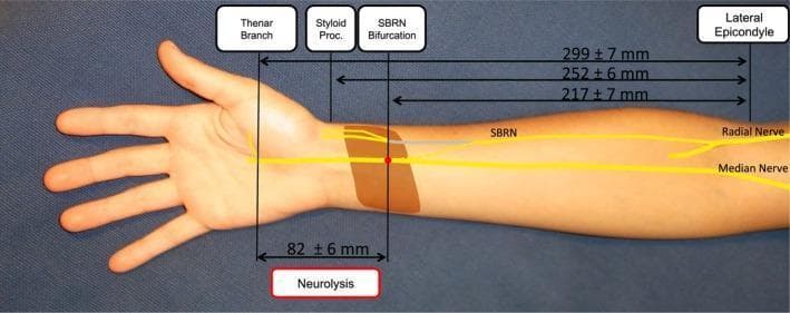 Anatomical diagram and clinical photograph overlaying a human forearm to demonstrate the nerve transfer of the superficial branch of the radial nerve (SBRN) to the median nerve (MN). The visual illustrates the surgical anatomy and morphometric distances required for neurolysis and tension-free coaptation. Key landmarks identified from the lateral epicondyle of the humerus include the SBRN bifurcation (217 ± 7 mm), the radial styloid process (252 ± 6 mm), and the thenar branch takeoff (299 ± 7 mm). The original course of the SBRN is indicated in gray, while the post-transposition path toward the median nerve is shown as a dashed yellow line, with the coaptation site marked by a red dot. A brown highlighted area represents the pronator quadratus muscle. The diagram also specifies an 82 ± 6 mm segment required for interfascicular neurolysis between the median nerve and its thenar branch to facilitate the transfer. This educational material is designed for advanced orthopedic or plastic surgery training in peripheral nerve reconstruction.